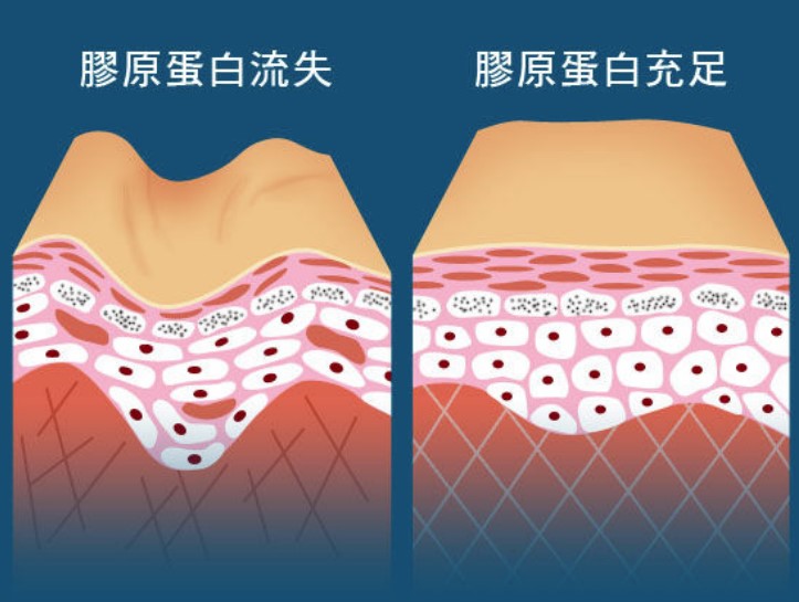 膠原蛋白流失令皮膚容易長出皺紋示意圖