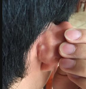 耳後長痘痘