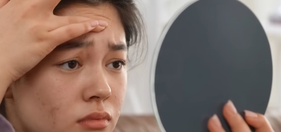 (額頭出油長痘痘原因)