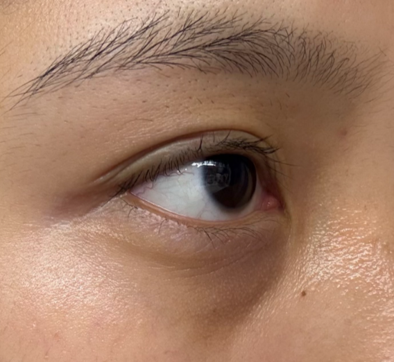 紫色黑眼圈怎麼遮
